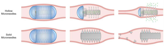 therapeutic-use illustration of the microneedle pill