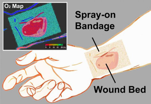 Smart Bandage Shows Tissue Oxygen Levels