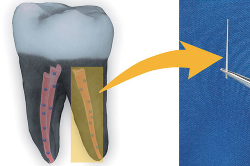 tooth filled with nanodiamond-enhanced gutta percha
