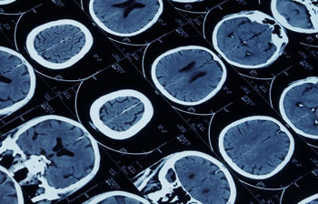 MRI can identify blood clots in the brain