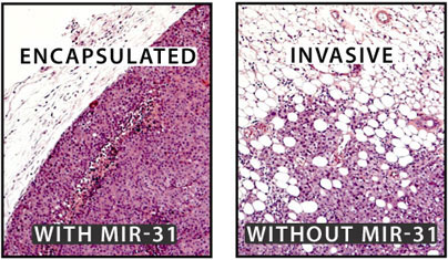 >In mice, the loss of microRNA miR-31 allows cancer cells to spread to the lungs more easily than cancer cells with miR-31