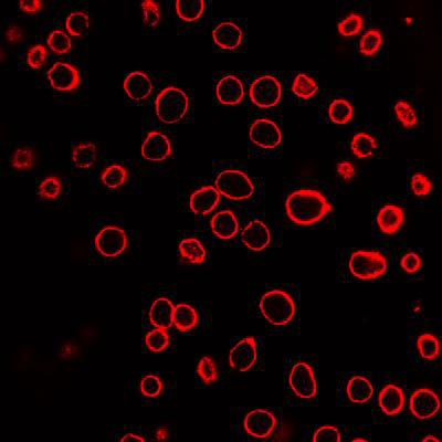A field of human prostate cancer cells is shown after exposure to laser-activated carbon nanoparticles. The cell membranes have been stained red to assist in visualization. Each of the red circles is a single cell