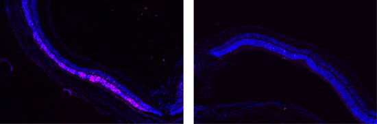 Image on left shows damage (pink) to the retina. Image on right show that POD GDNF nanoparticles protected the retina from damage.
