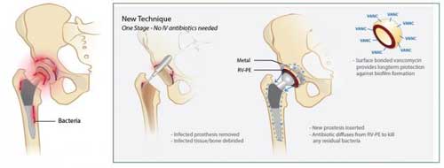 Prosthetic Hip with Vancomycin-Releasing Polymer