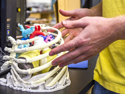 3-D print of an optimized, patient-specific artificial heart