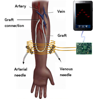 blood-pressure sensor embedded inside a prosthetic graft