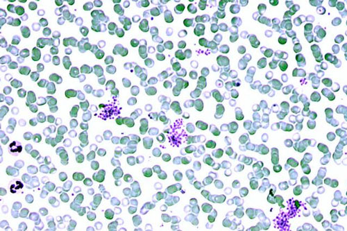 Red blood cells from a patient infected with Plasmodium falciparum