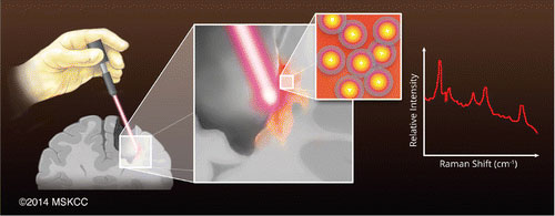 Guiding Brain Tumor Resection Using Surface-Enhanced Raman Scattering Nanoparticles