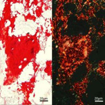 >New bone matrix that formed within the implanted nanobone pellets stains red with Picrosirius (left) and has a characteristic pattern under polarised light (right)