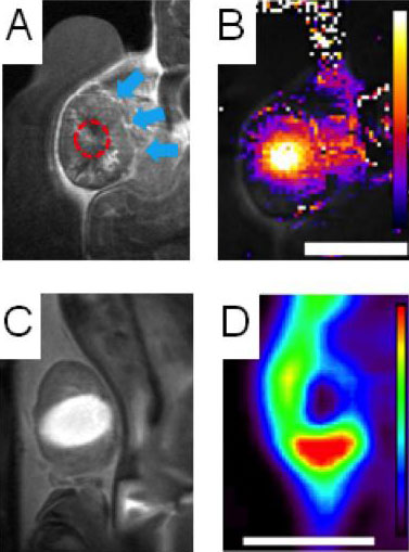 Ultrasound Plus Nanoparticle Chemo Destroys Tumors in Mice