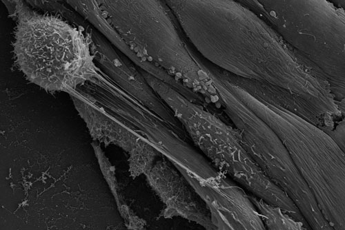 A rounded cancer cell sends out nanotubes connecting with endothelial cells