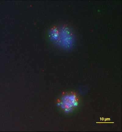 Fluorescence probes in two breast cancer cells give information about which genes are present