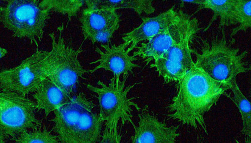 Fluorescent images of breast carcinoma cell line