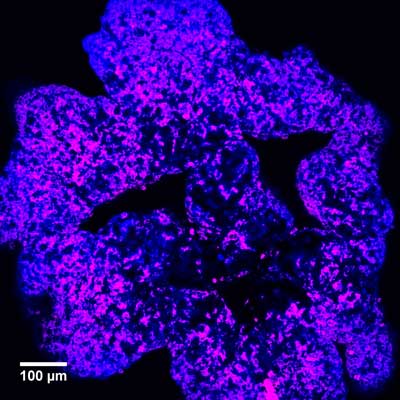 Model of cancer cells (blue) containing iron oxide nanoparticles (magenta)