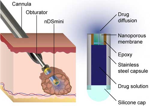 Nanochannel Implants for Minimally-Invasive Insertion and Intratumoral Delivery