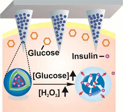 Tiny, painless microneedles on a patch can deliver insulin in response to rising glucose levels