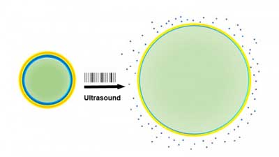 When drug-laden nanoparticles (left) absorb energy from ultrasound waves, their liquid center (green) turns to gas and expands the particles (right), loosening their exterior and releasing the drug (blue)