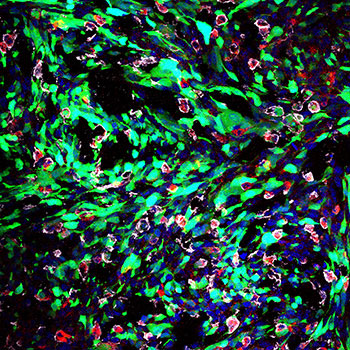 Nanoparticles (in red) being taken up in the brain of a live rat model with glioblastoma (in green)
