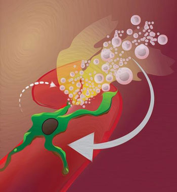 Macrophage-mediated Vascular Bursting