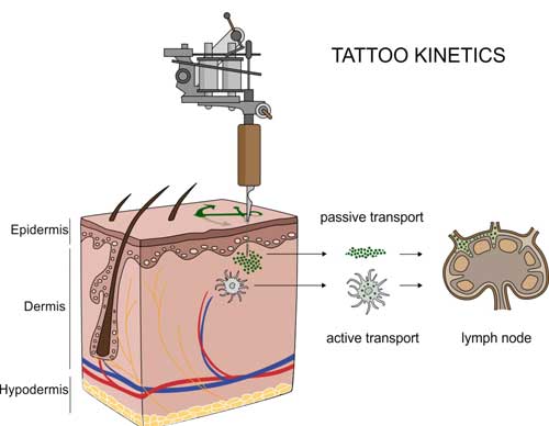 Translocation of tattoo particles from skin to lymph nodes
