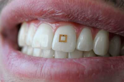 A miniaturized sensor mounted on a tooth