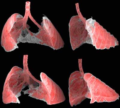The figure shows two views, frontal and lateral, of the image obtained by CT of the lungs of a mouse with fibrosis (grey areas) before and after receiving nano-therapy directed at senescent cells