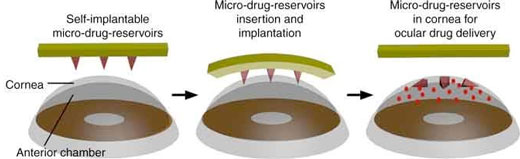 an eye patch for ocular drug delivery is equipped with an array of self-implantable micro-drug-reservoirs
