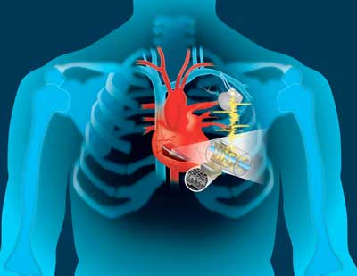 Device to Capture Cardiac Energy