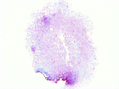 Stem cell with formation of cartilage related proteins from growth factor loaded nanoparticles