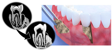 Hierarchically Patterned Polydopamine-Containing Membranes for Periodontal Tissue Engineering