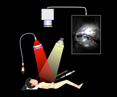 image-guided surgical system that could help surgeons better visualize and remove tiny ovarian tumors