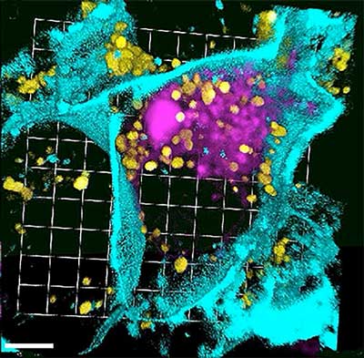 Pancreatic Cancer Cell Treated with Silencing RNA Nanoparticles