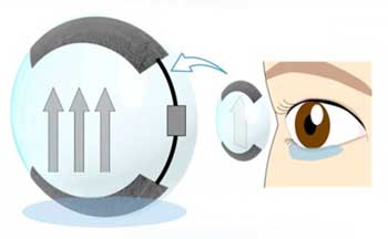 Illustration of a self-moisturising soft contact lens that supplies tears via electroosmotic flow from the temporary tear reservoir behind the lower eyelid