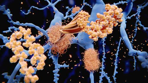 The amyloid-beta peptide accumulates to amyloid fibrils that build up dense amyloid plaques