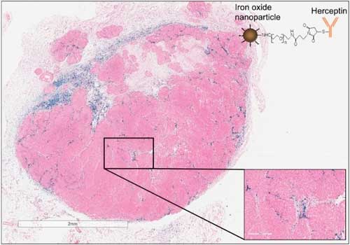 Histology image of HER2+ tumor showing accumulation of Herceptin-labeled nanoparticles