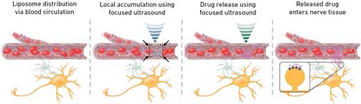 Scheme of the two-step procedure for accumulating and finally releasing encapsulated drugs locally