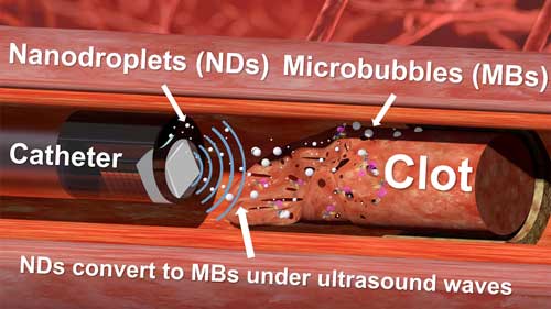 Nanodroplet-Mediated Catheter-Directed Sonothrombolysis of Retracted Blood Clots