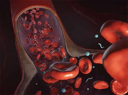 Red blood cell hitchhiking enhances the accumulation of nano- and micro-particles in the constriction of a stenosed microvessel