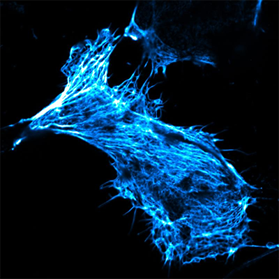 Living human cancer cell in cell culture, its actin skeleton stained with fluorescent phalloidin