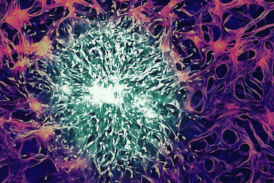 Las células tumorales (verde) están rodeadas de células endoteliales (púrpura).