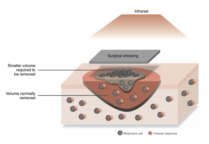 graphene oxide elastin surgical dressing