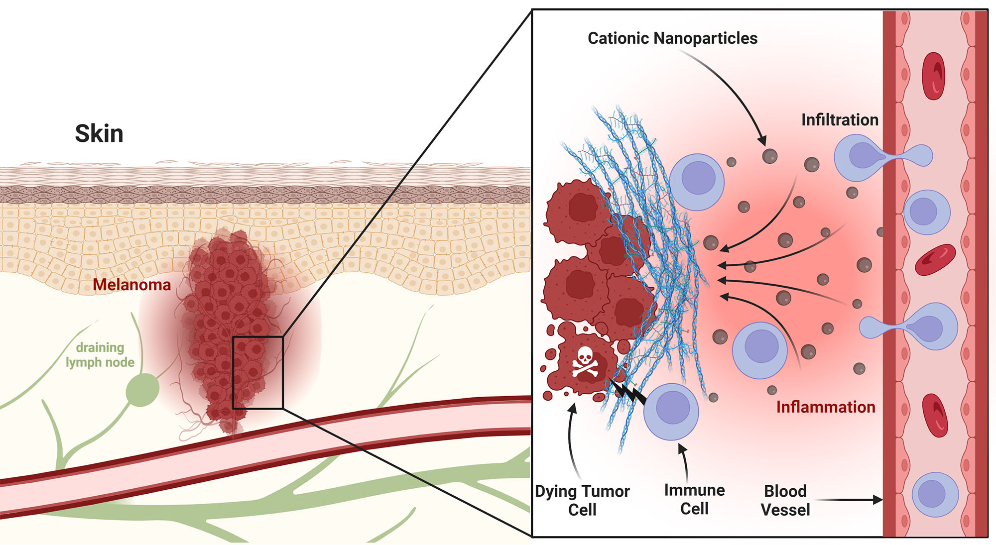a graphic showing skin with a tumor (melanoma) and other components such as blood and lymphatic vessels; the magnified portion of the graph shows how nanoparticles attract stimulated immune cells to the tumor site