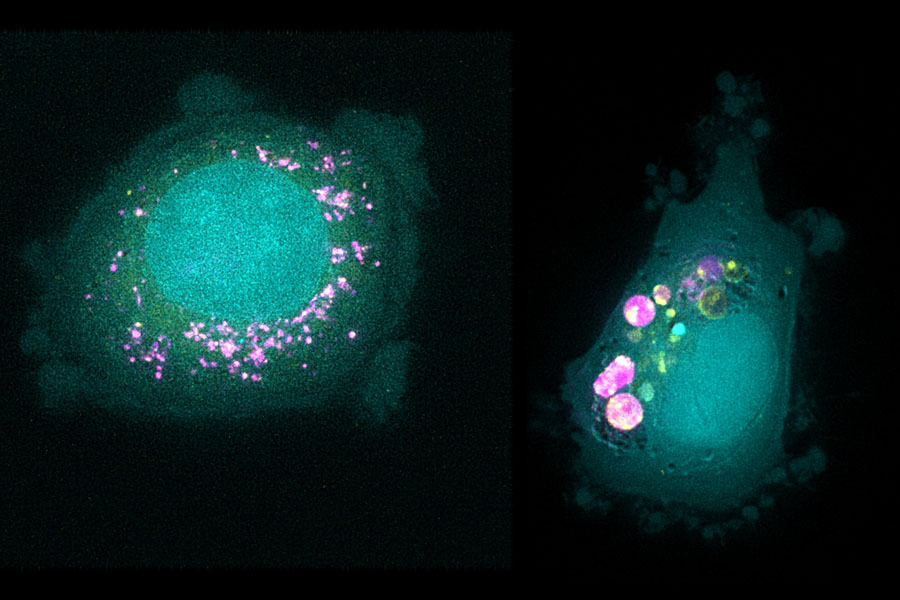cancer cells with liposomes