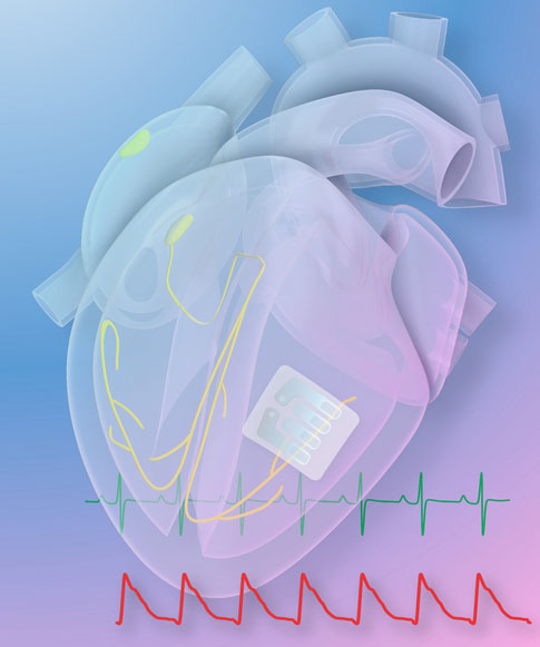 Illustration of the graphene tattoo on a human heart
