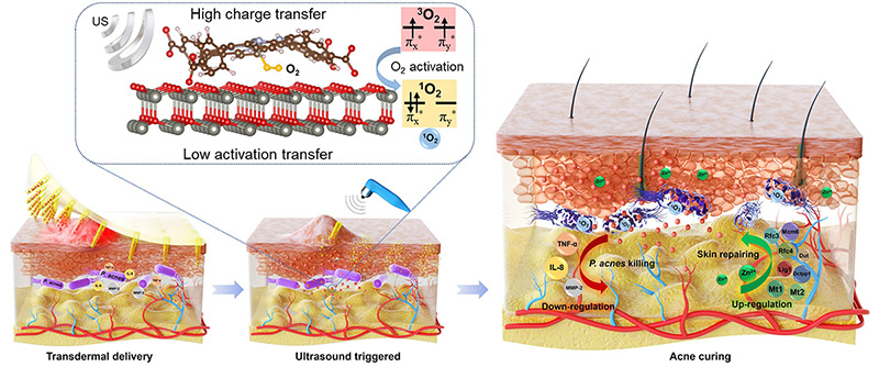 Treatment of acne through efficient ultrasound-triggered antibacterial nanoparticles embedded microneedle patch