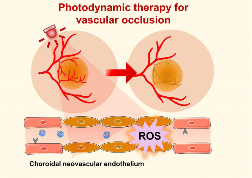 Photodynamic therapy (PDT) offers a clinical solution by utilising non-toxic photosensitisers activated by specific wavelengths of light to generate reactive oxygen species (ROS), which can damage and obliterate neovascularisation