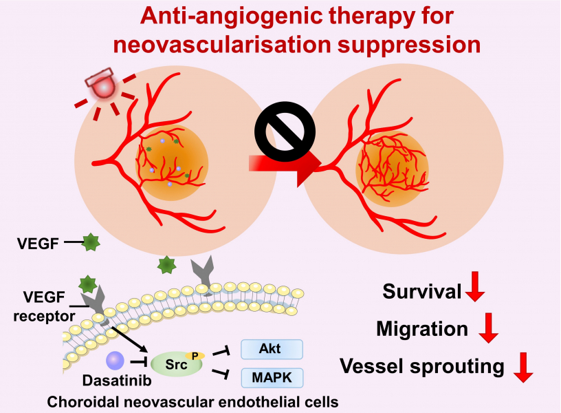 Anti-angiogenic therapy suppresses choroidal neovascularisation (CNV) by inhibiting vascular endothelial growth factor (VEGF)-related pathways