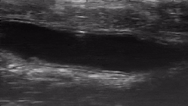 Live ultrasound footage shows a microrobot tumbling through a colon in vivo