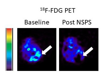 tumor before and after treatment