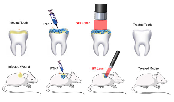 Two sets of graphics showing scenarios where nanoparticles and near infrared light are used to destroy biofilms in infected teeth and wounded skin